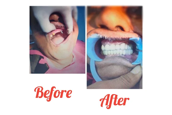 Before and After