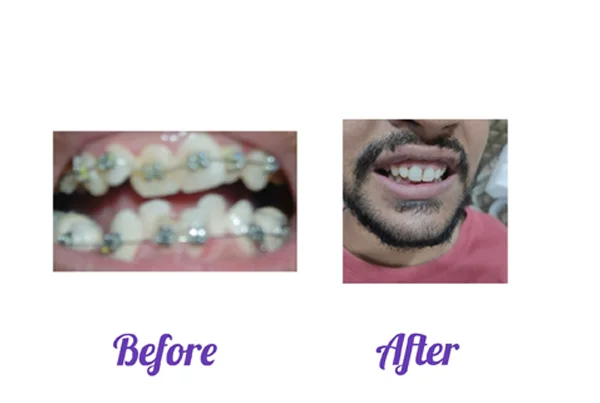 Before and After
