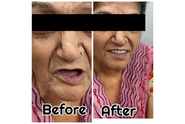 Before and After