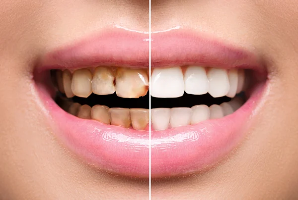 Full Mouth Rehabilitation