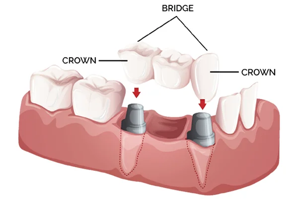 Crown and Bridges