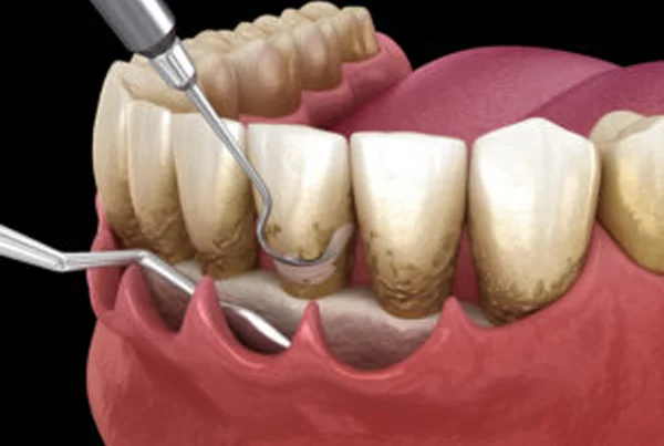 Periodontal